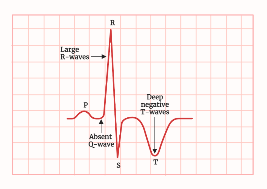 ECG (Electrocardiogram)